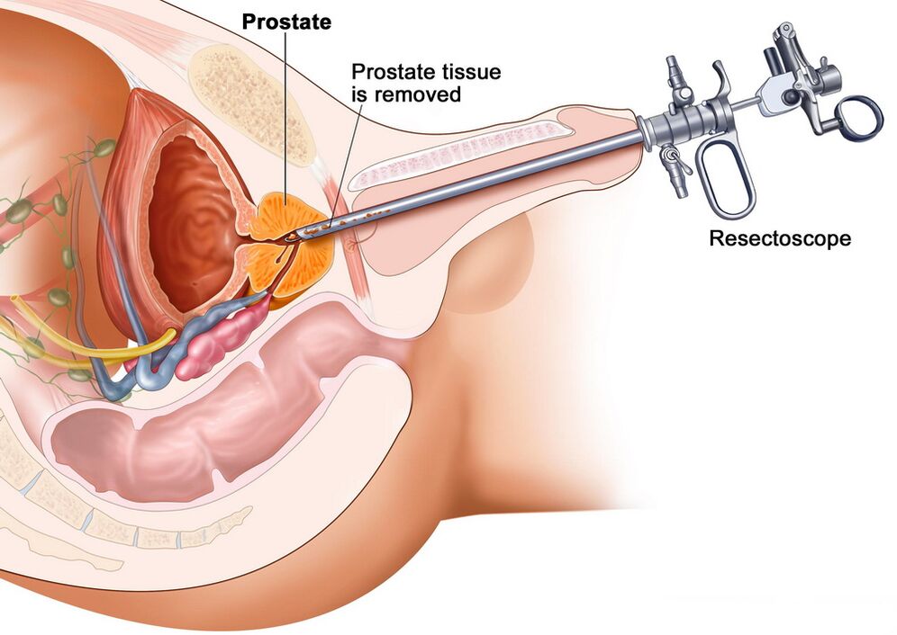 Ablation du tissu prostatique pour un diagnostic précis de la prostatite